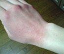ゴム手袋による、 ラテックスアレルギー